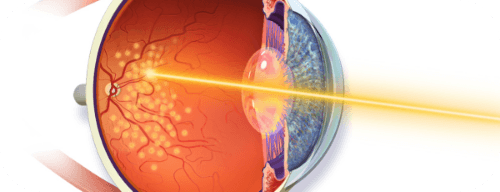 Retinal laser Center img